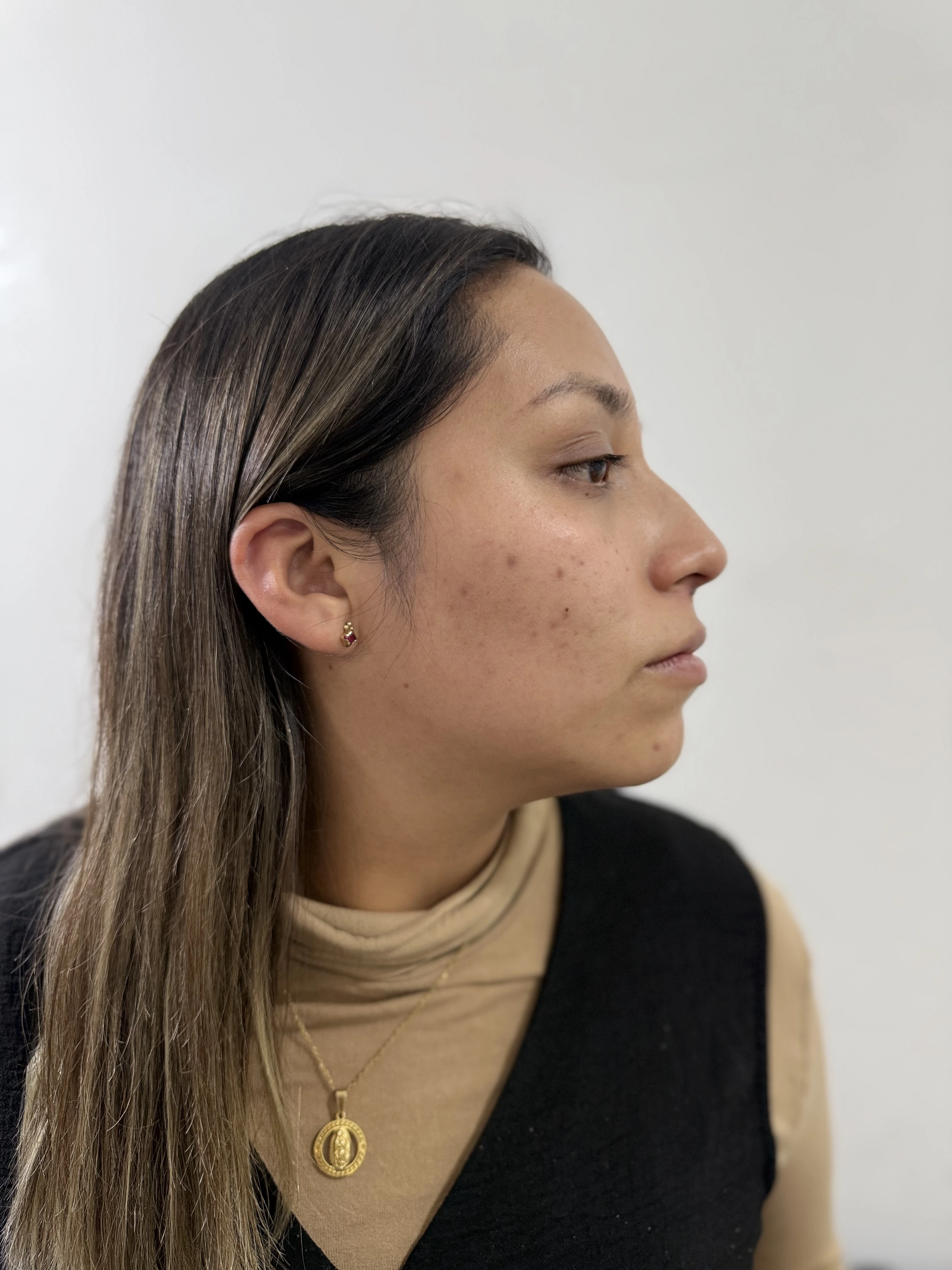 Antes del tratamiento de ácido hialurónico